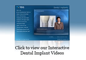 Présentation d’Implants dentaires